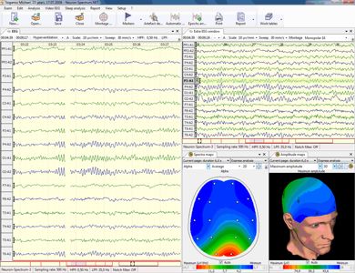 3D mapovanie EEG aktivity