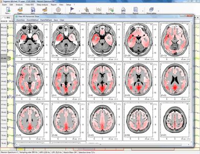 Automatické prepojenie s programom BrainLoc alebo Loreta/sLoreta